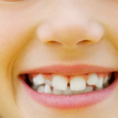 Crooked Teeth